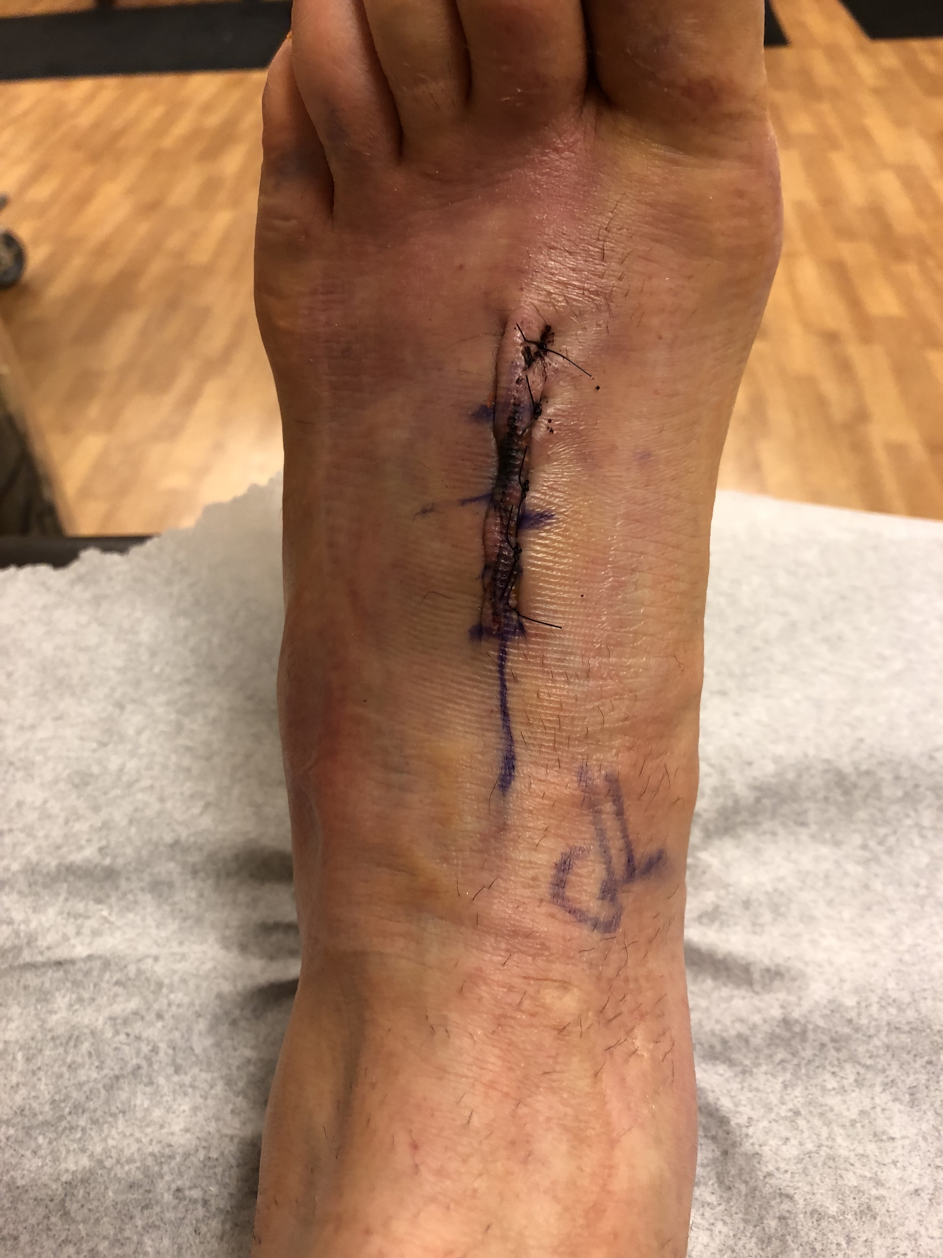 foot surgery
